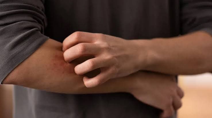Aumento dei casi di dermatofilosi in Europa: Pregliasco rassicura sul rischio, ma avverte dei cambiamenti nei contagi